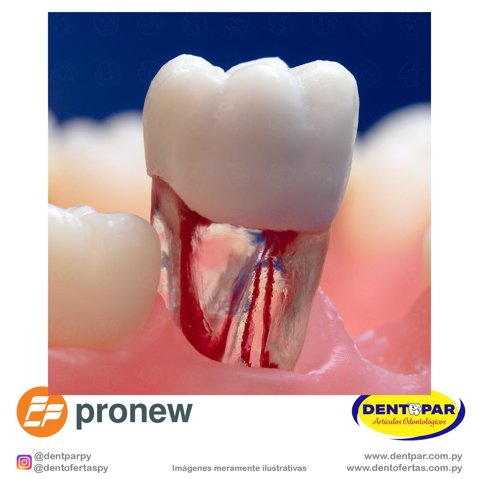 Imagen del producto Diente Endo Transparente con Caries Oculta